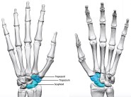 Tri scaphoid Osteoarthritis Aberdeen Virtual Hand Clinic
